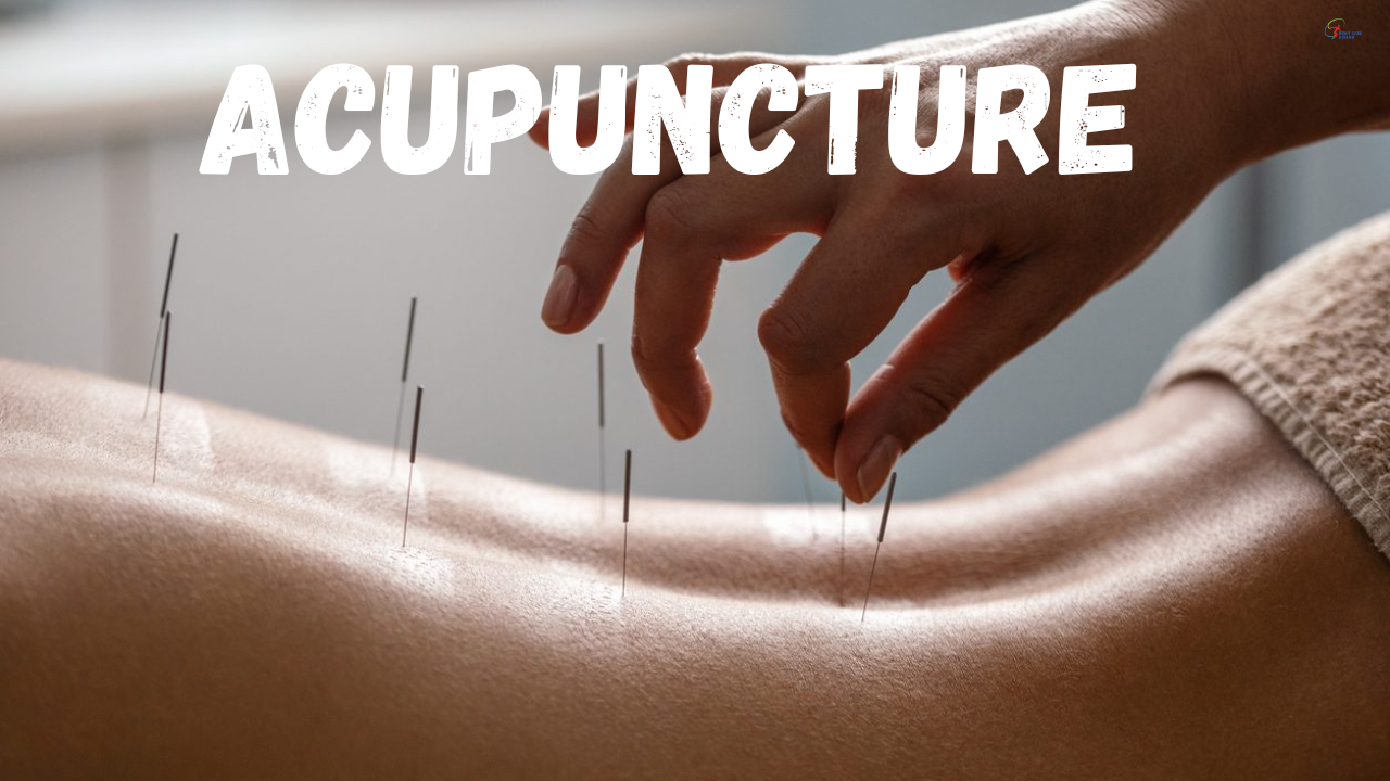 ACUPUNCTURE