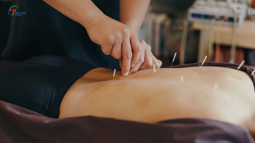 ACUPUNCTURE