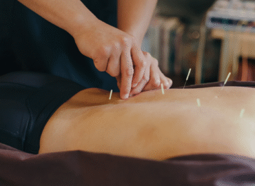 ACUPUNCTURE ACUPUNCTURE
